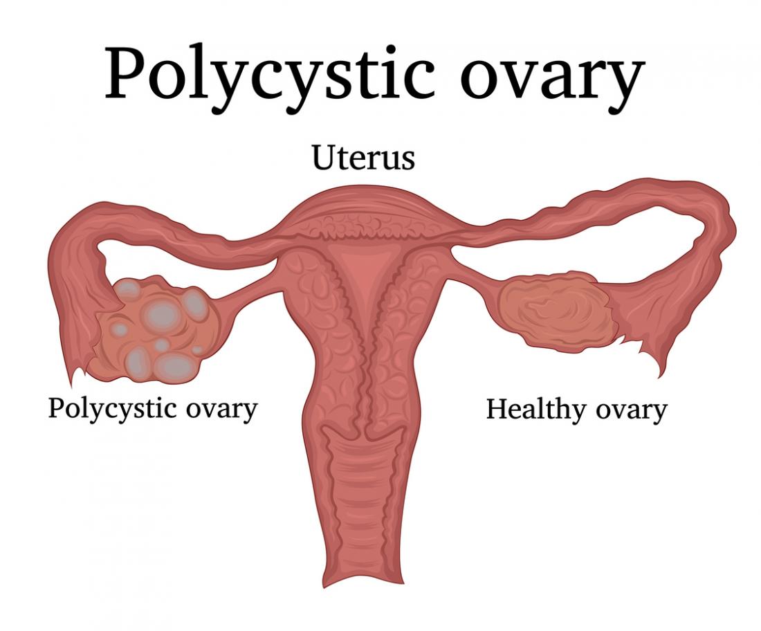 Between Polycystic Ovarian Syndrome (PCOS) and Conception